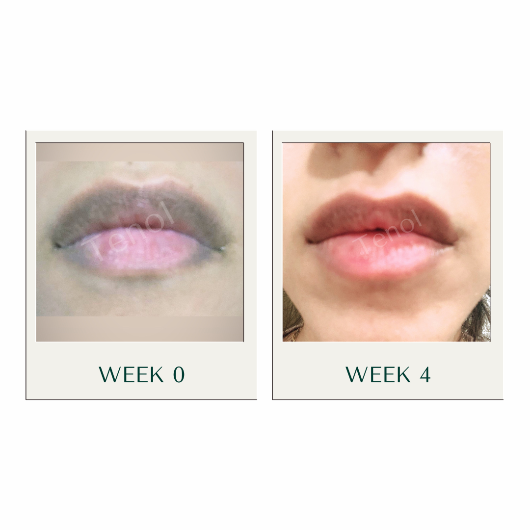 Tenol Lip Remedy Kit (Regular Strength Kit) - Reverse Lip Hyperpigmentation and Repair Lips TenolCare ScentiMelti Wax Melts