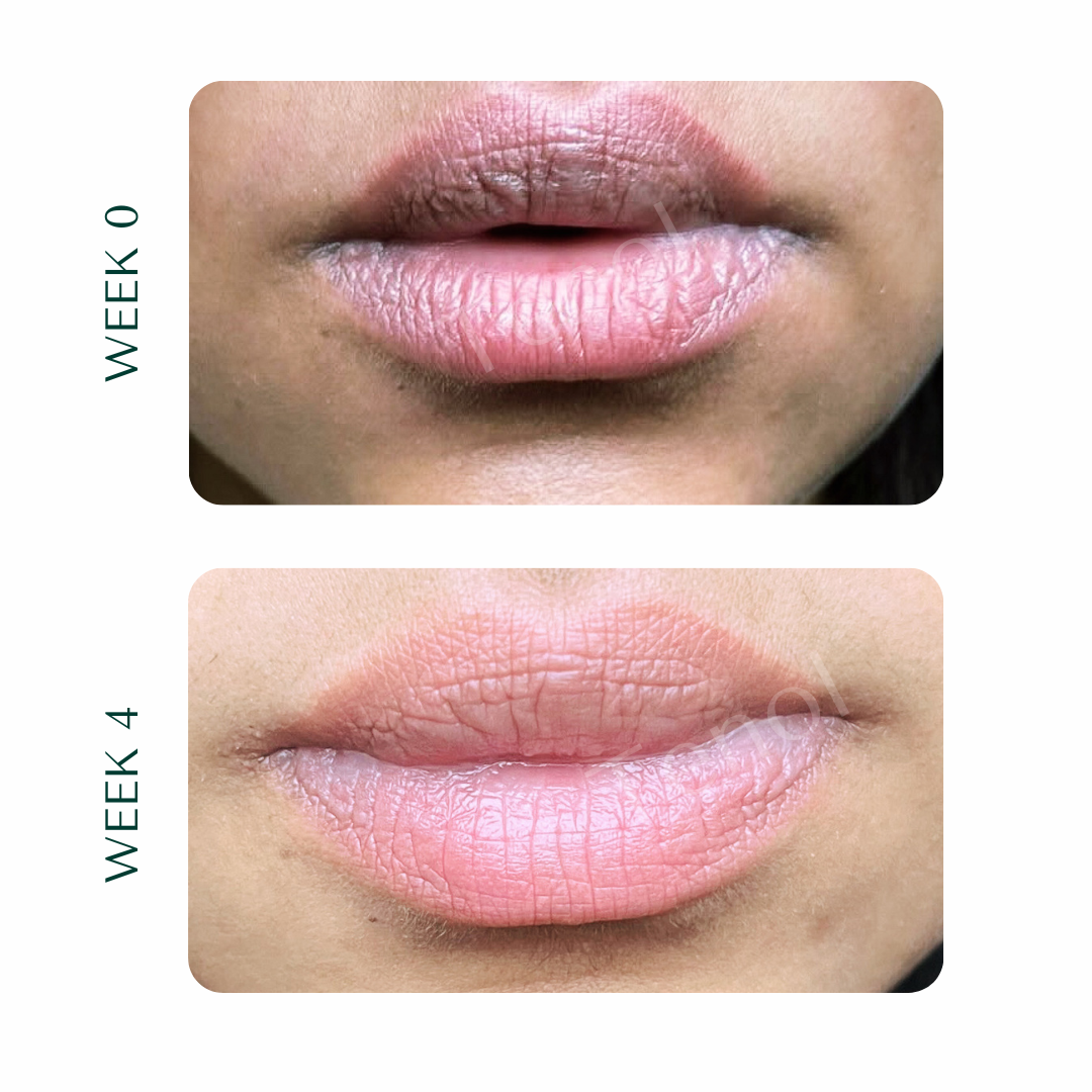 Tenol Lip Remedy Kit (Regular Strength Kit) - Reverse Lip Hyperpigmentation and Repair Lips TenolCare ScentiMelti Wax Melts