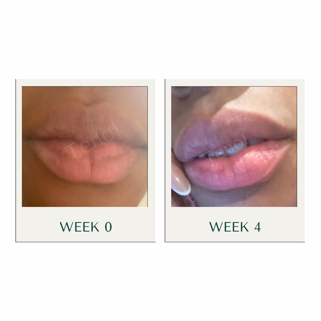 Tenol Lip Remedy Kit (Regular Strength Kit) - Reverse Lip Hyperpigmentation and Repair Lips TenolCare ScentiMelti Wax Melts