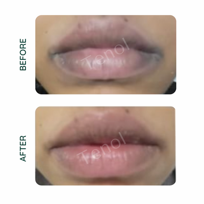 Tenol Lip Remedy Balm - Treatment for Lip Hyperpigmentation / Discolouration - ScentiMelti  Tenol Lip Remedy Balm - Treatment for Lip Hyperpigmentation / Discolouration