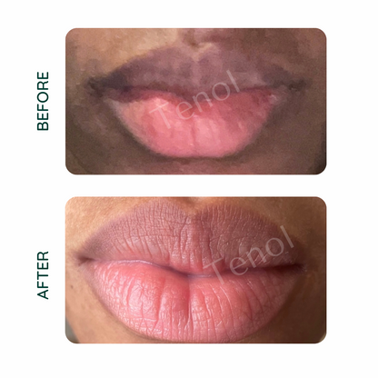 Tenol Lip Remedy Balm - Treatment for Lip Hyperpigmentation / Discolouration - ScentiMelti  Tenol Lip Remedy Balm - Treatment for Lip Hyperpigmentation / Discolouration