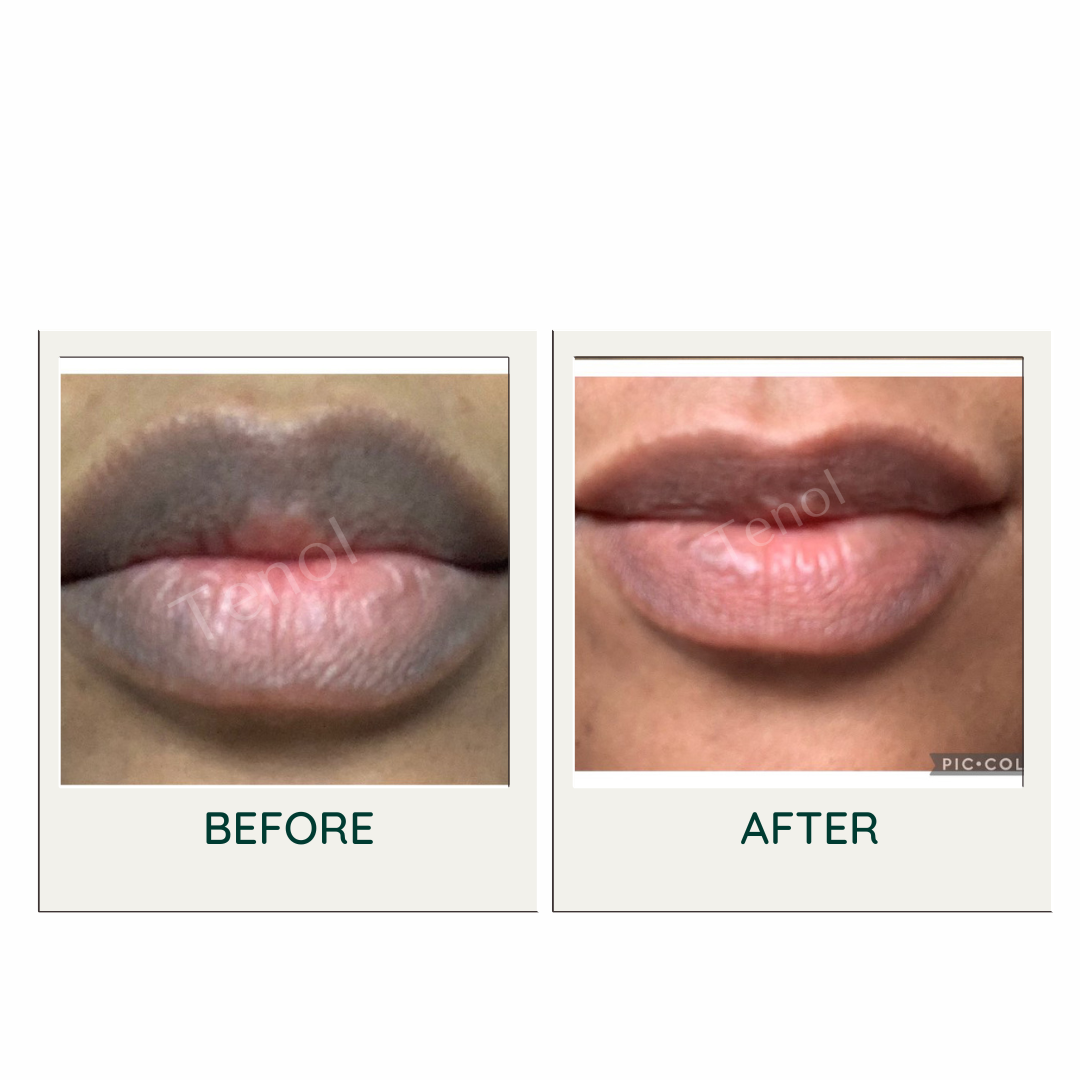 Tenol Lip Remedy Balm - Treatment for Lip Hyperpigmentation / Discolouration